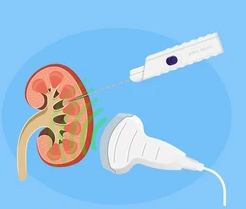 Kidney Biopsy