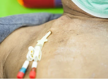 Permcath Insertion