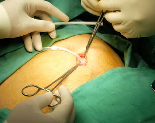 Peritoneal Dialysis Catheter Insertion