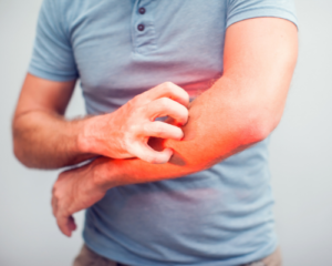 itching in dialysis